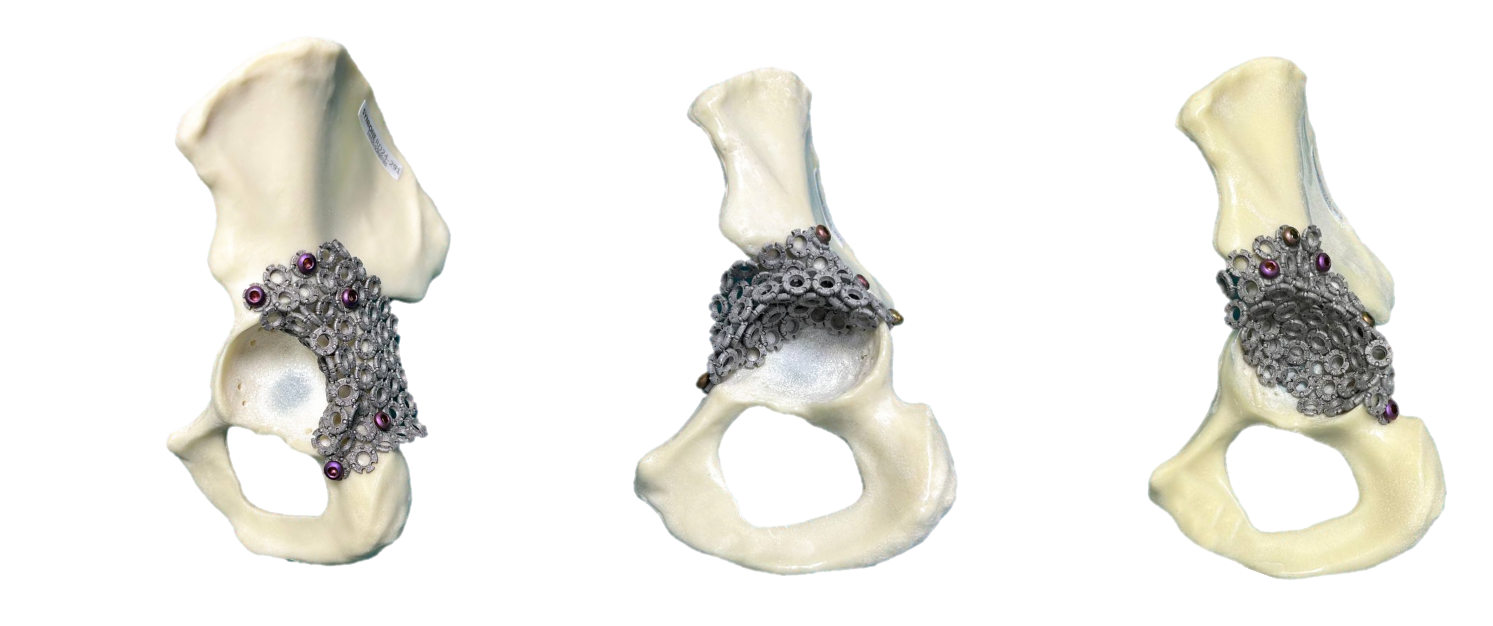 Three views of the OrthoClay implant fixed to the pelvis with locking screws