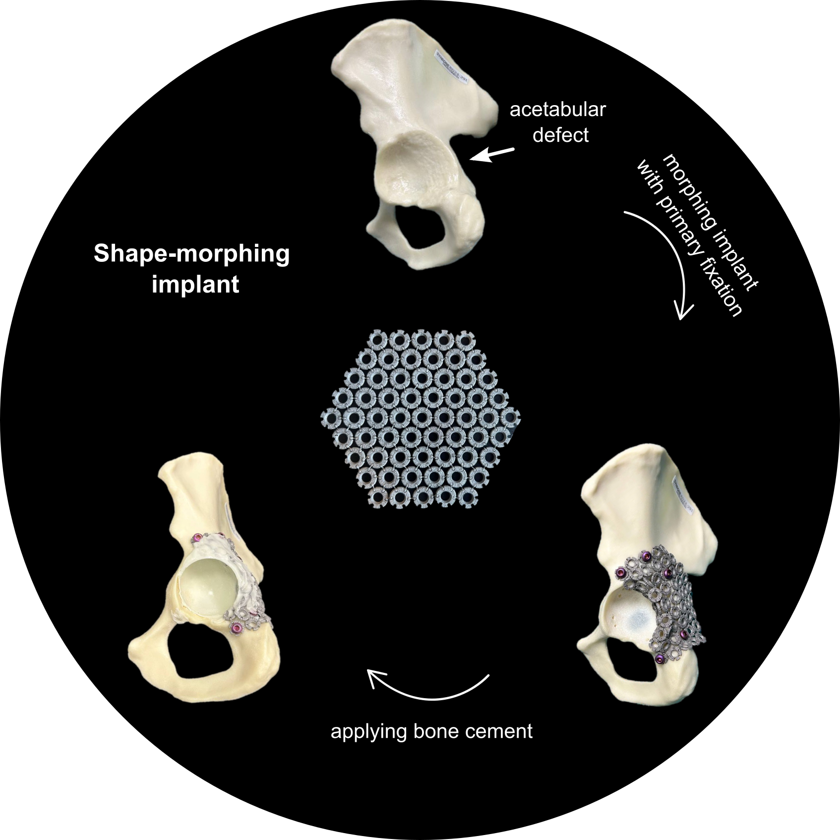 OrthoClay solution workflow: from acetabular defect to shape-morphing implant